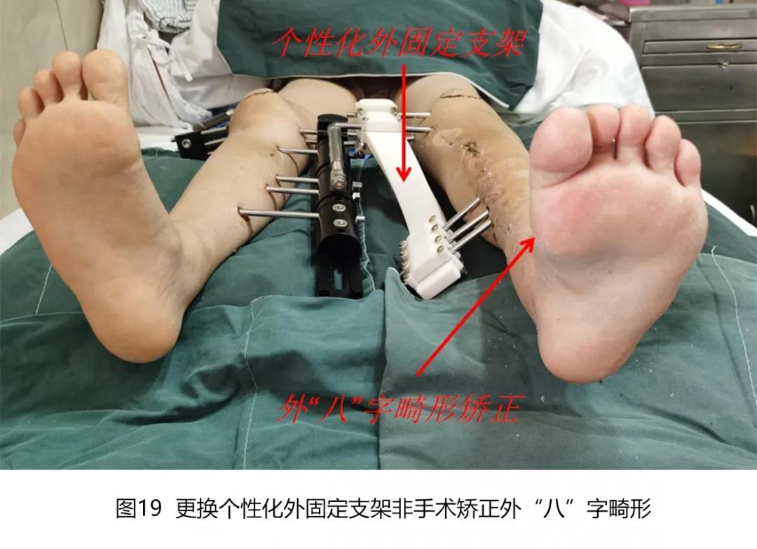 广州市第一人民医院借助智能数字技术实现下肢复杂畸形微创,三维精准